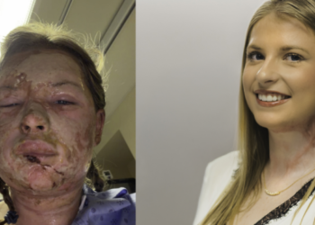 World-first burn treatment shows ‘remarkable’ results in Canadian patient