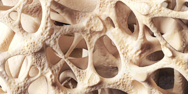 Osteopenia is silently weakening bones in millions of people