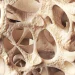 Osteopenia is silently weakening bones in millions of people