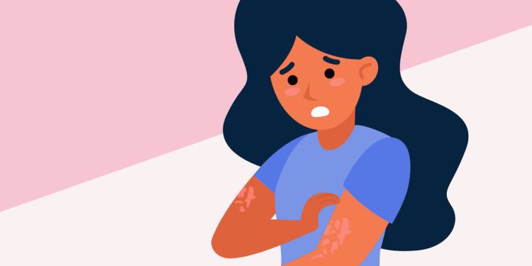 Facts About Chronic Spontaneous Urticaria