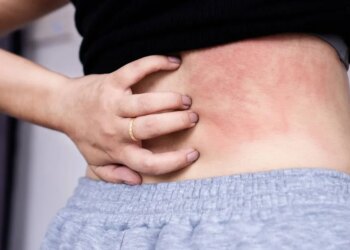 Living with Chronic Spontaneous Urticaria
