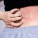 Living with Chronic Spontaneous Urticaria